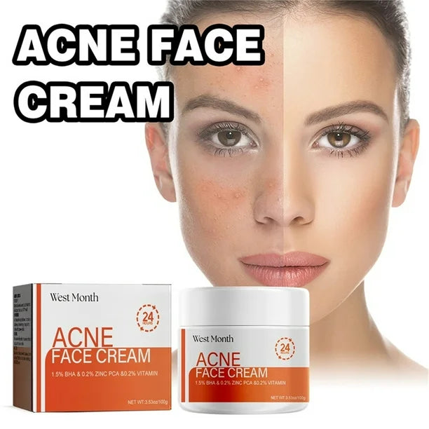 Crema para quitar el acné y las marcas