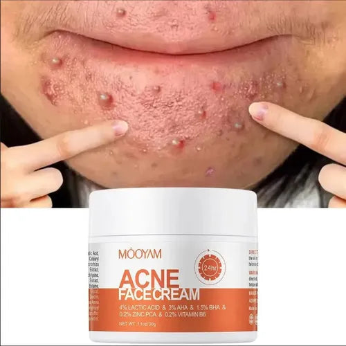 Crema para quitar el acné y las marcas