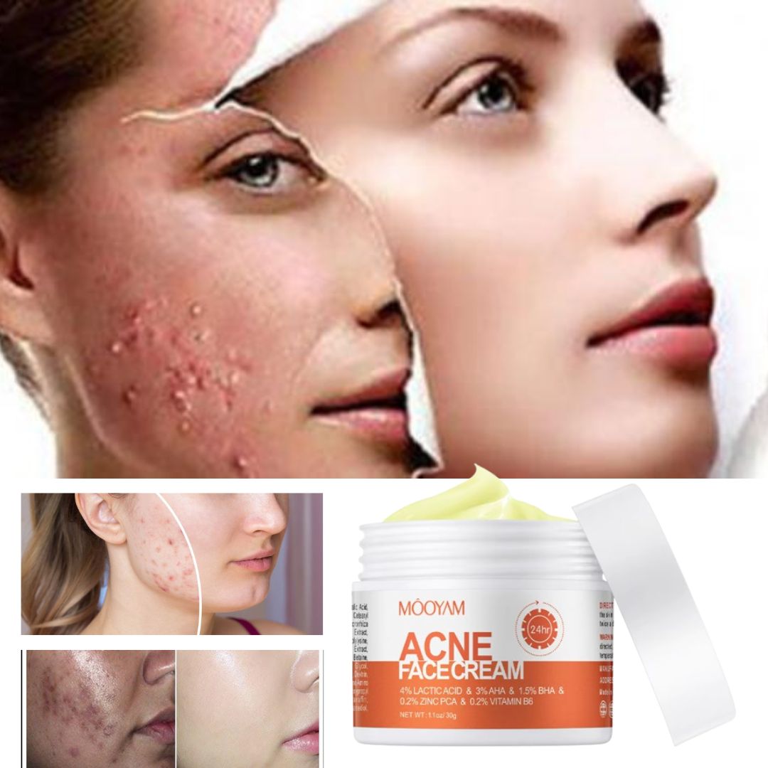 Crema para quitar el acné y las marcas